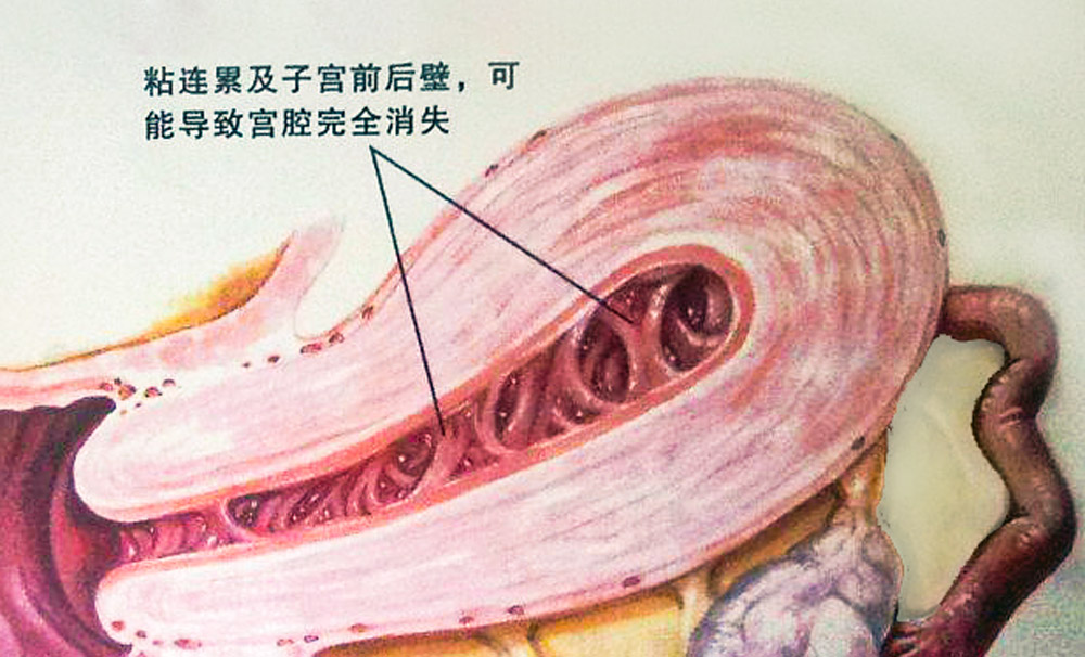 宮腔粘連