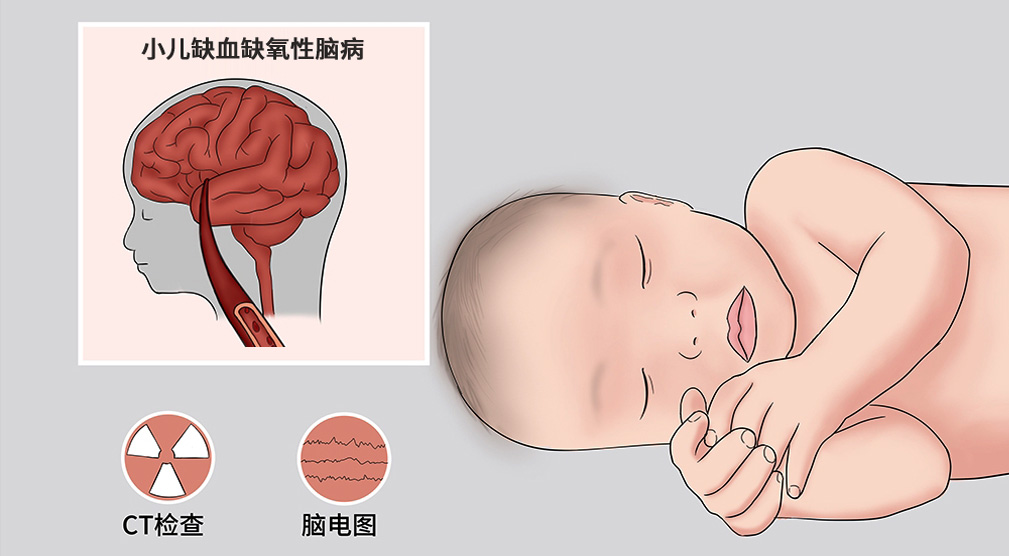 缺氧缺血性腦病