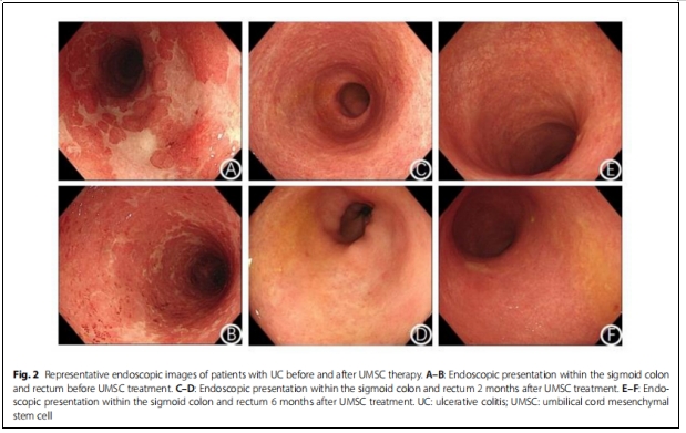 UC-MSCs移植2個(gè)月，73.2%潰瘍性結(jié)腸炎患者達(dá)到臨床緩解，43.9%患者經(jīng)歷粘膜愈合！